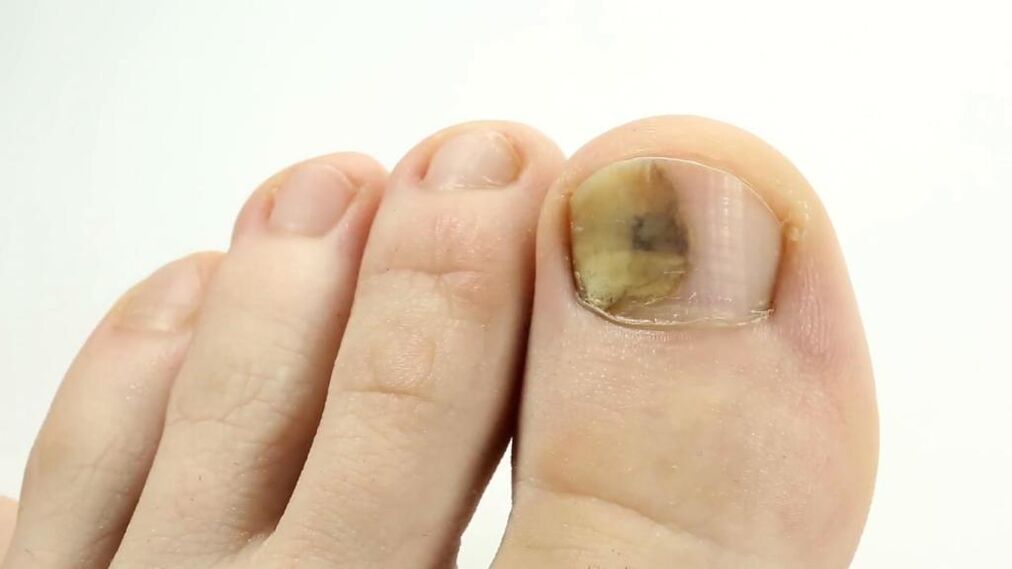 Appearance of toenails affected by fungus